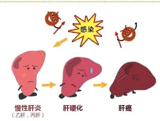 黄色网站香蕉视频厂家提醒肝脏疾病治不好？要了解是否含铁食物摄入多